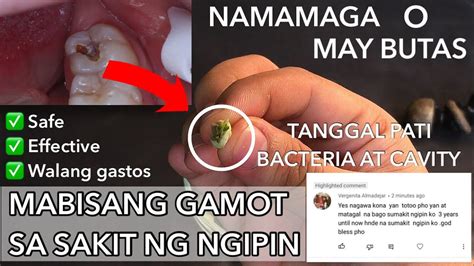 Gamot Sa Sakit Ng Ngipin: Ano Ba Ang Mabisang .